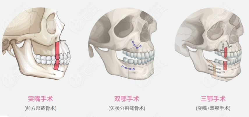 骨性凸嘴做正颌手术费用是多少