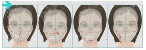 骨性偏頜臉歪正頜矯正手術(shù)全程多少錢(qián)