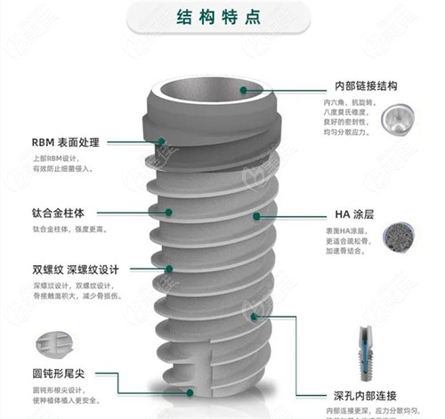 话说国产的大清西格种植体怎么样