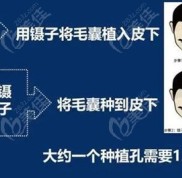 沈陽植發(fā)醫(yī)院哪家實力好