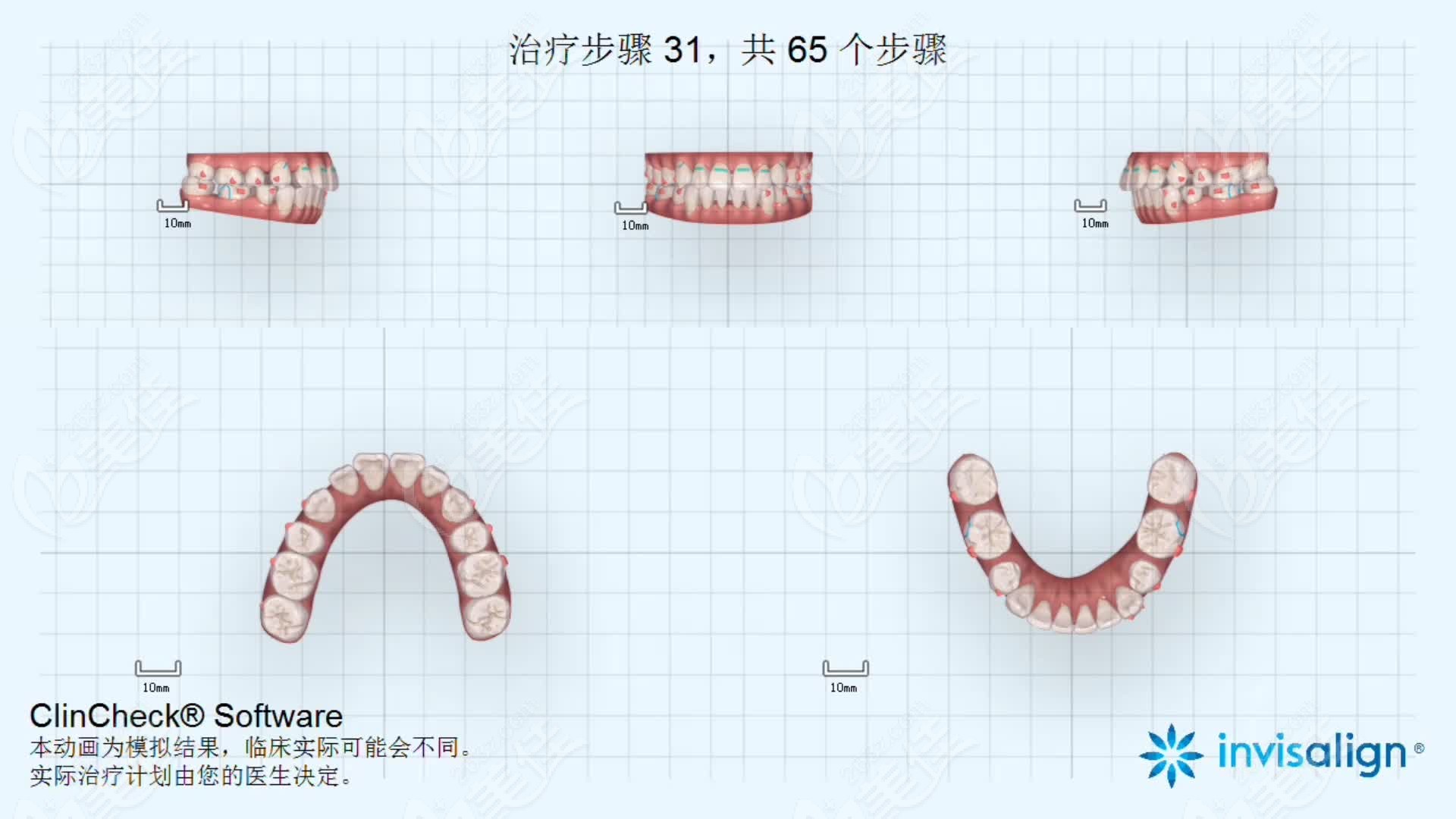 在隐适美牙套的8个系列中