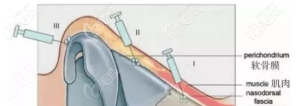 目睹過注射玻尿酸隆鼻后悔了的經(jīng)歷