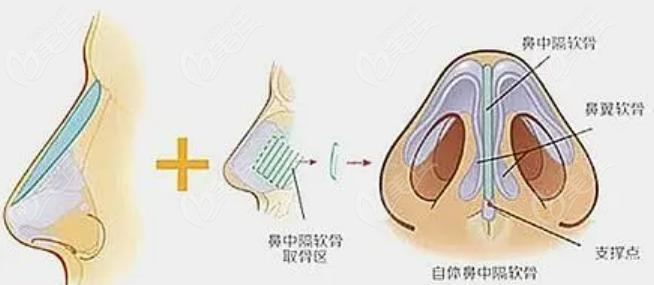 西安藝星綜合隆鼻怎么樣