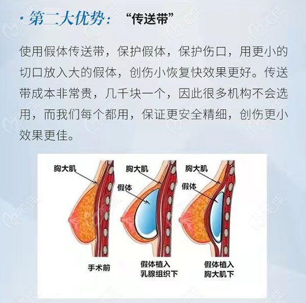 3分鐘了解上海唐毅醫(yī)生隆胸做的怎么樣及他胸部下垂提升的口碑