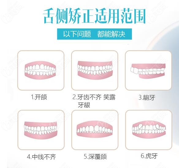 南京舌侧矫正哪里可以做