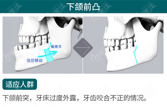 地包天矯正手術(shù)哪里做得好