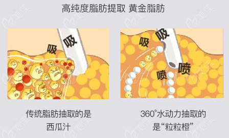上新的南京华美吸脂价格表中有华美医院做大腿抽脂多少钱