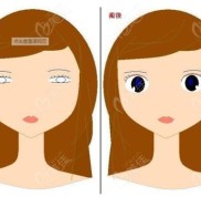 哈爾濱藝星整形宋楠醫(yī)生做雙眼皮口碑咋樣呀