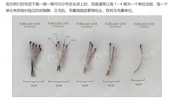 上海秃顶植发价位公示啦