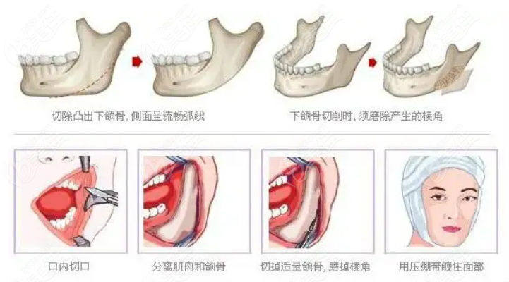 下頜角整形手術(shù)過(guò)程揭秘