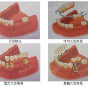 寧波鑲牙多少錢一顆