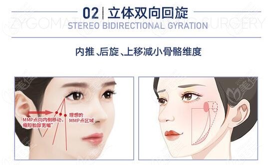 成都做颧骨内推医生李继华的磨骨风格和价格怎么样呢