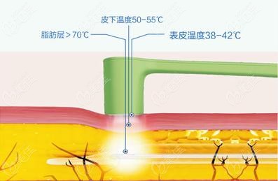 做黄金微雕瘦脸会出现面部凹陷或嘴歪的情况吗