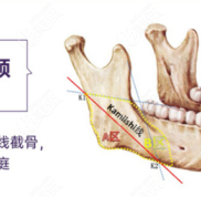 在貴陽做下頜角截骨好的醫(yī)院里做削骨整形需要多少錢呢