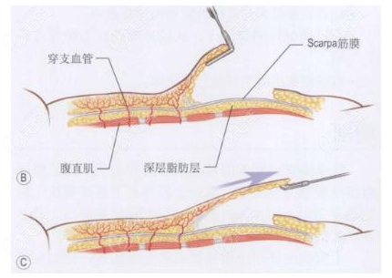 腹壁整形術(shù)到底有多痛呀