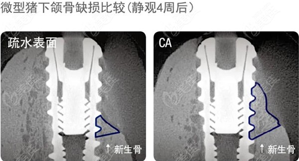 韩国奥齿泰钙离子亲水种植体TSIII CA系统