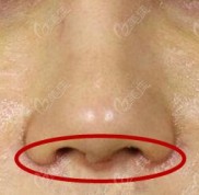如果做鼻整形手術(shù)會(huì)留下疤痕
