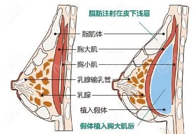 西安哪个医生做隆胸手术好