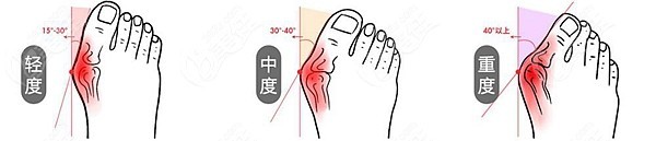 鄭州做拇指外翻手術(shù)的醫(yī)院排名