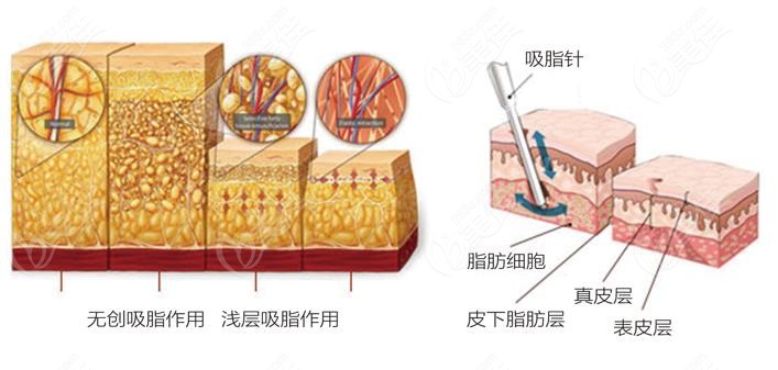 生孩子前抽脂好還是生完孩子后好