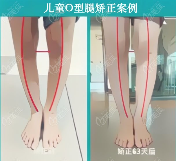 上海o型腿矫正哪家医院好