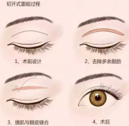 石家莊雅芳亞整形做全切雙眼皮怎么樣
