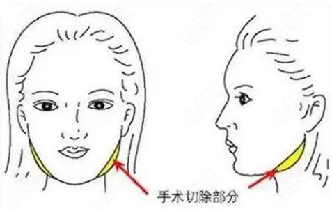 北京做下颌角手术好的医生推荐