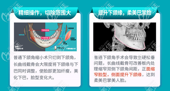 2022廣州下頜角手術(shù)醫(yī)生排名