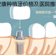 在安康市做種植牙比較好的醫(yī)院名單和收費價格都打探到了
