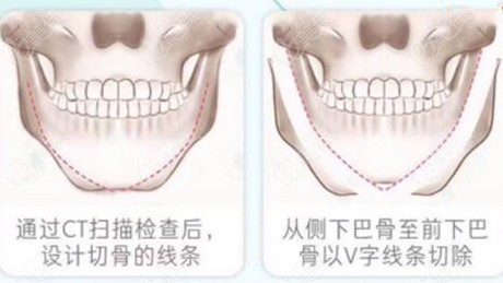 為什么下巴T型截骨手術(shù)不建議做