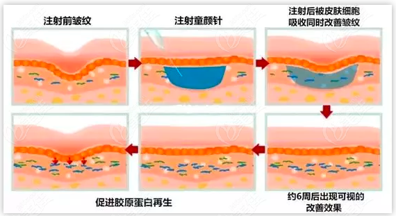 誰知道少女針和童顏針的區(qū)別是啥