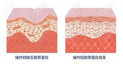 做熱瑪吉除皺緊膚前先看下熱瑪吉全臉抗衰包括哪些部位