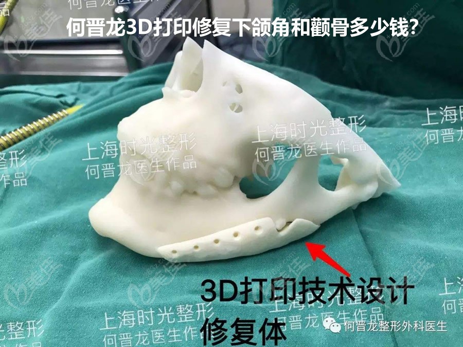 上海何晋龙医生3D打印修复下颌角和颧骨颧弓的收费标准