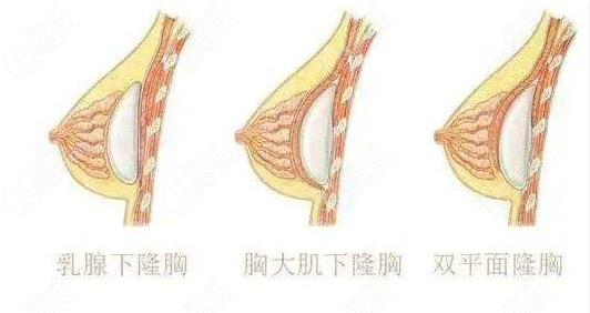 假體300cc的屬于什么罩杯的啊