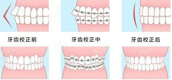 正颌手术后不正畸可以吗