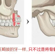 重慶骨性凸嘴手術(shù)哪個(gè)醫(yī)院醫(yī)生做的好