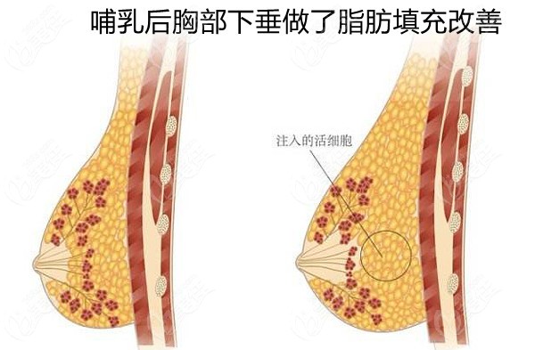 介绍银川华美整形做脂肪丰胸技术咋样时把隆胸要花多少钱也说了