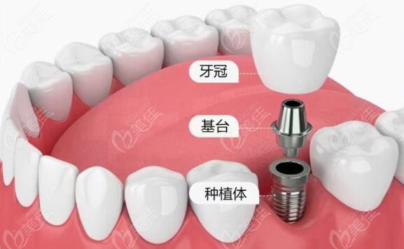 亳州益雅口腔价格表