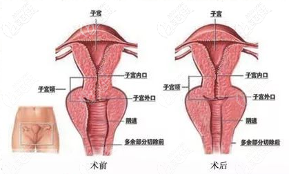 為什么要做陰唇整形手術(shù)