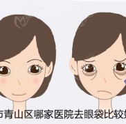 來分享包頭市青山區(qū)哪家醫(yī)院去眼袋比較好了