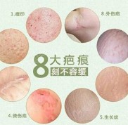 許昌做激光祛疤多少錢