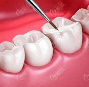哈爾濱美中口腔堵牙多少錢