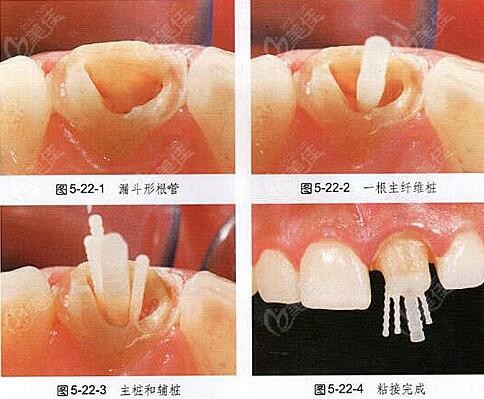 純鈦牙樁和纖維牙樁哪個(gè)好