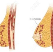 在海南做自體脂肪隆胸價(jià)格要多少錢(qián)