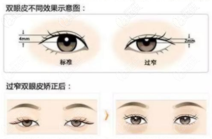 说上海做双眼皮修复厉害的医生有唐毅