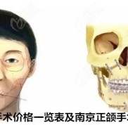 2024新版南京正頜手術(shù)價(jià)格一覽表及南京正頜手術(shù)報(bào)銷政策來啦