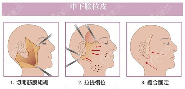 更新西宁拉皮医院排名以及做面部拉皮手术多少钱一次