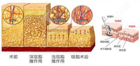 像大腿/腰腹脂肪易堆積的同一個部位可以反復(fù)吸脂幾次