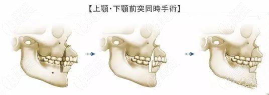 正颌后需要终身佩戴保持器吗