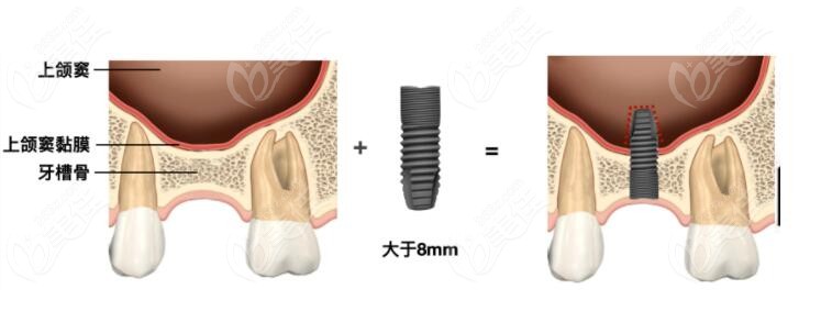 种植牙为什么要做上颌窦提升